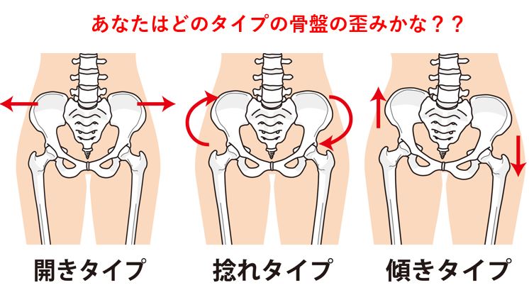 骨盤ズレのタイプ 奈良市整体